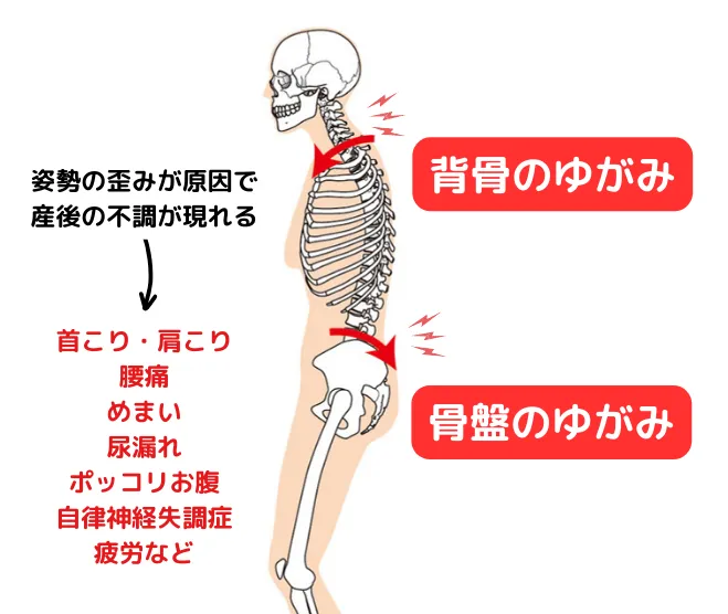 産後の不調のと姿勢の歪みの関係図