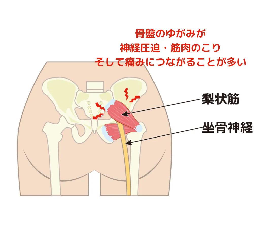 坐骨神経痛のおこる原因