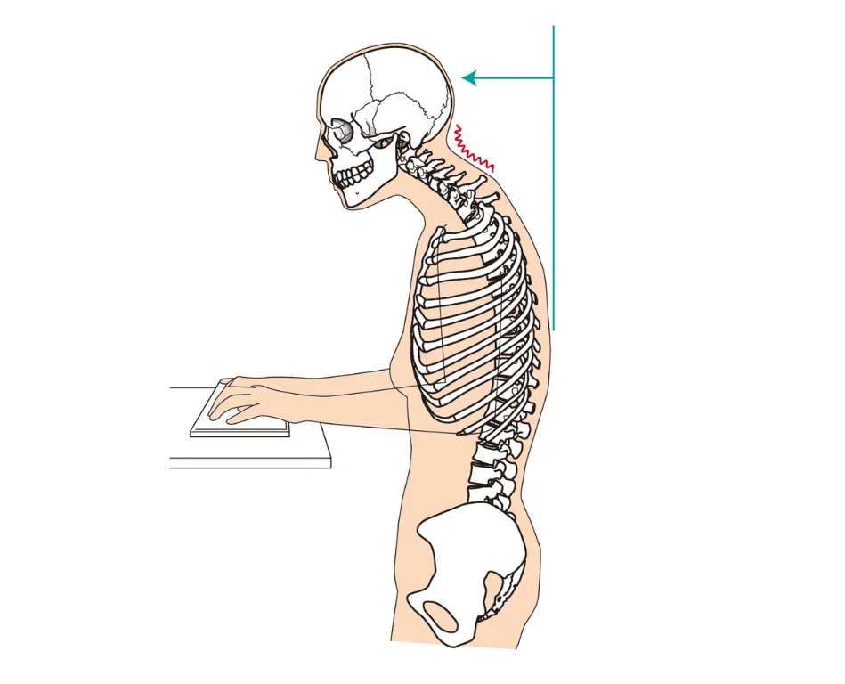パソコン作業が原因のストレートネック