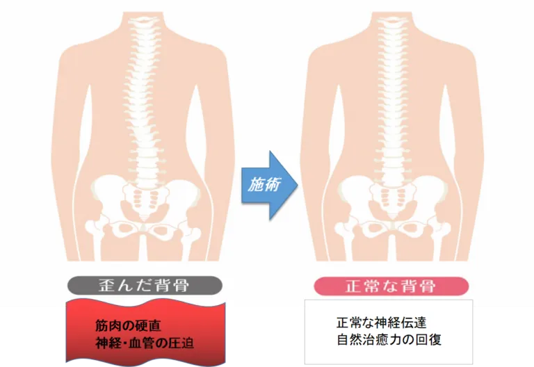 歪んだ背骨と正常な背骨の比較図